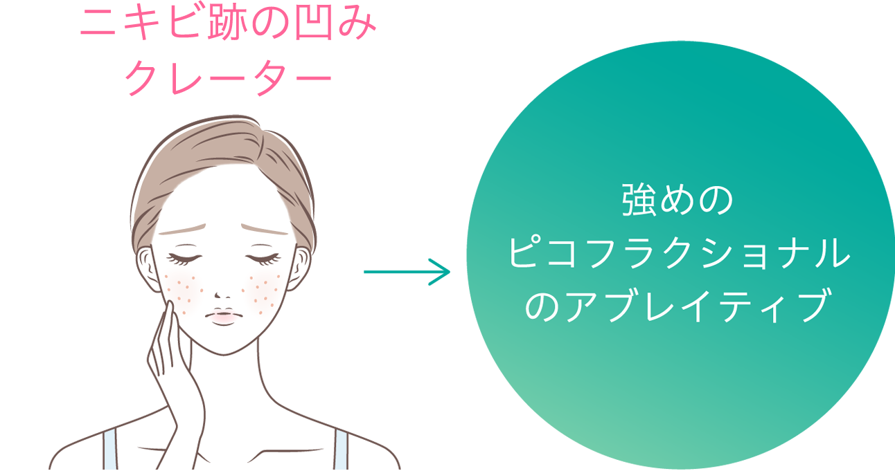 ニキビ跡の凹みクレーター